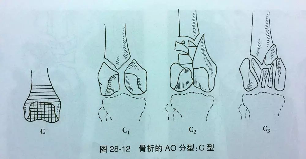 完全关节内髁间骨折,为髁间t形及y形骨折(    28-12).