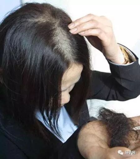 每次洗头都大把掉发，八成是这个原因，女性中招最多