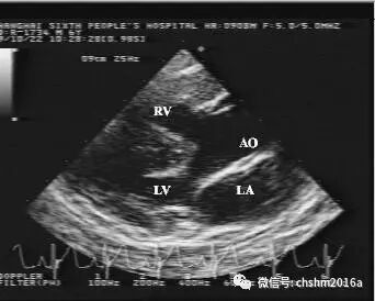 彩超伪像是什么先天性心脏病超声诊断（超声梦影像医生集团 CCM）_https://www.jmylbn.com_新闻资讯_第13张