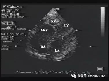 彩超伪像是什么先天性心脏病超声诊断（超声梦影像医生集团 CCM）_https://www.jmylbn.com_新闻资讯_第17张