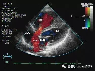 彩超伪像是什么先天性心脏病超声诊断（超声梦影像医生集团 CCM）_https://www.jmylbn.com_新闻资讯_第5张