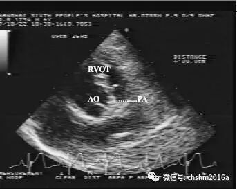 彩超伪像是什么先天性心脏病超声诊断（超声梦影像医生集团 CCM）_https://www.jmylbn.com_新闻资讯_第14张