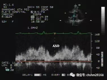 彩超伪像是什么先天性心脏病超声诊断（超声梦影像医生集团 CCM）_https://www.jmylbn.com_新闻资讯_第4张