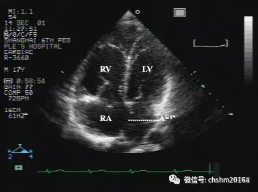 彩超伪像是什么先天性心脏病超声诊断（超声梦影像医生集团 CCM）_https://www.jmylbn.com_新闻资讯_第3张