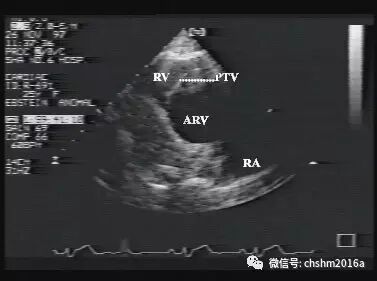 彩超伪像是什么先天性心脏病超声诊断（超声梦影像医生集团 CCM）_https://www.jmylbn.com_新闻资讯_第18张