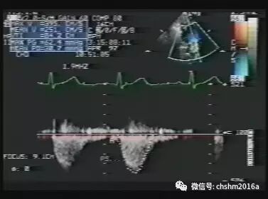 彩超伪像是什么先天性心脏病超声诊断（超声梦影像医生集团 CCM）_https://www.jmylbn.com_新闻资讯_第15张