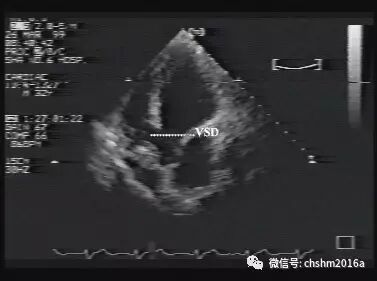 彩超伪像是什么先天性心脏病超声诊断（超声梦影像医生集团 CCM）_https://www.jmylbn.com_新闻资讯_第7张
