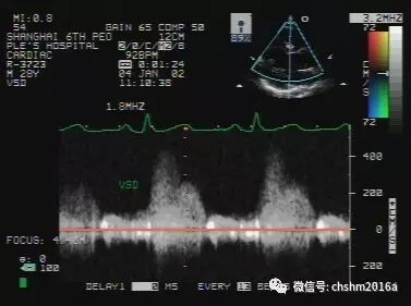 彩超伪像是什么先天性心脏病超声诊断（超声梦影像医生集团 CCM）_https://www.jmylbn.com_新闻资讯_第8张