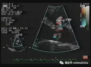 彩超伪像是什么先天性心脏病超声诊断（超声梦影像医生集团 CCM）_https://www.jmylbn.com_新闻资讯_第9张