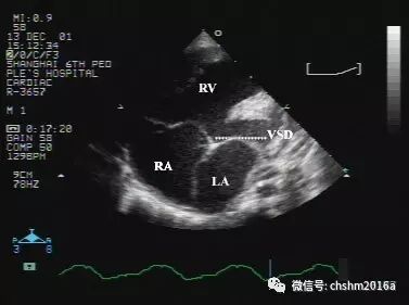 彩超伪像是什么先天性心脏病超声诊断（超声梦影像医生集团 CCM）_https://www.jmylbn.com_新闻资讯_第6张