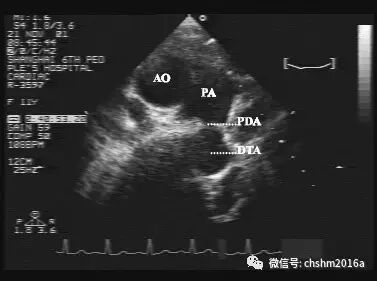 彩超伪像是什么先天性心脏病超声诊断（超声梦影像医生集团 CCM）_https://www.jmylbn.com_新闻资讯_第10张
