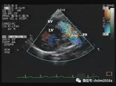 彩超伪像是什么先天性心脏病超声诊断（超声梦影像医生集团 CCM）_https://www.jmylbn.com_新闻资讯_第16张