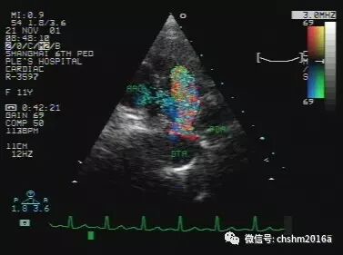 彩超伪像是什么先天性心脏病超声诊断（超声梦影像医生集团 CCM）_https://www.jmylbn.com_新闻资讯_第12张