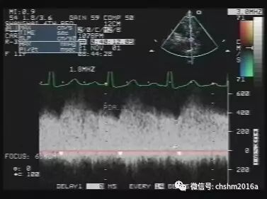 彩超伪像是什么先天性心脏病超声诊断（超声梦影像医生集团 CCM）_https://www.jmylbn.com_新闻资讯_第11张