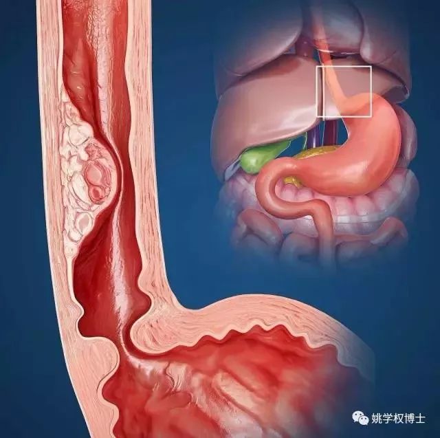 食道哪几个部位容易生癌 食道有三个生理狭窄部位——食管入口,食管和