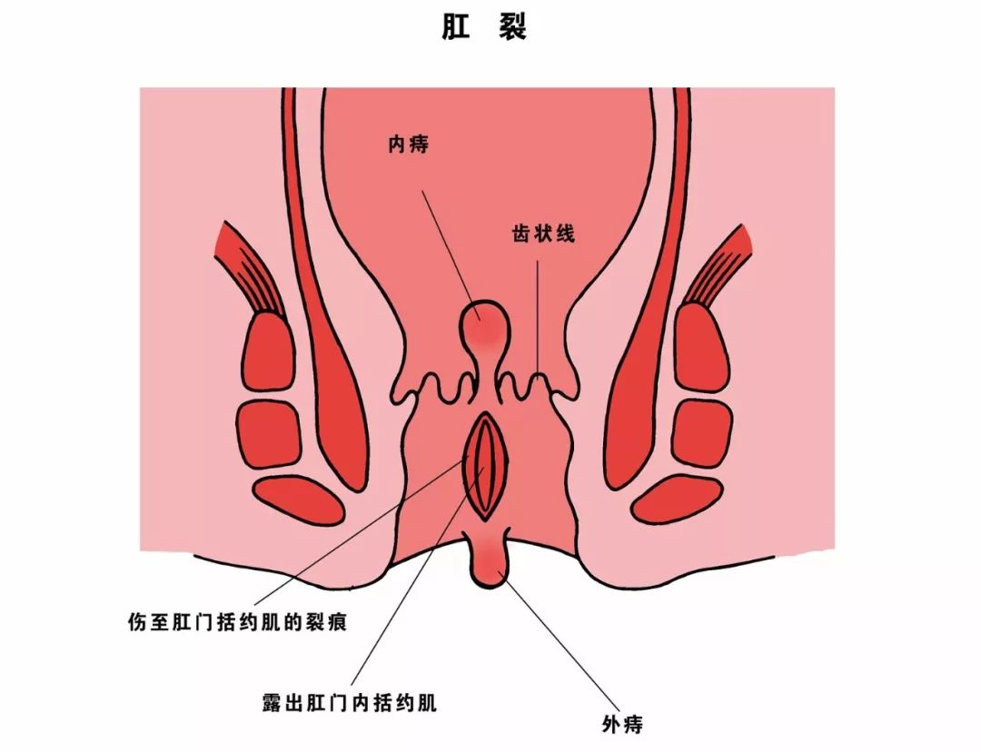 一个男人让肛肠医院打电话给老婆解释肛裂