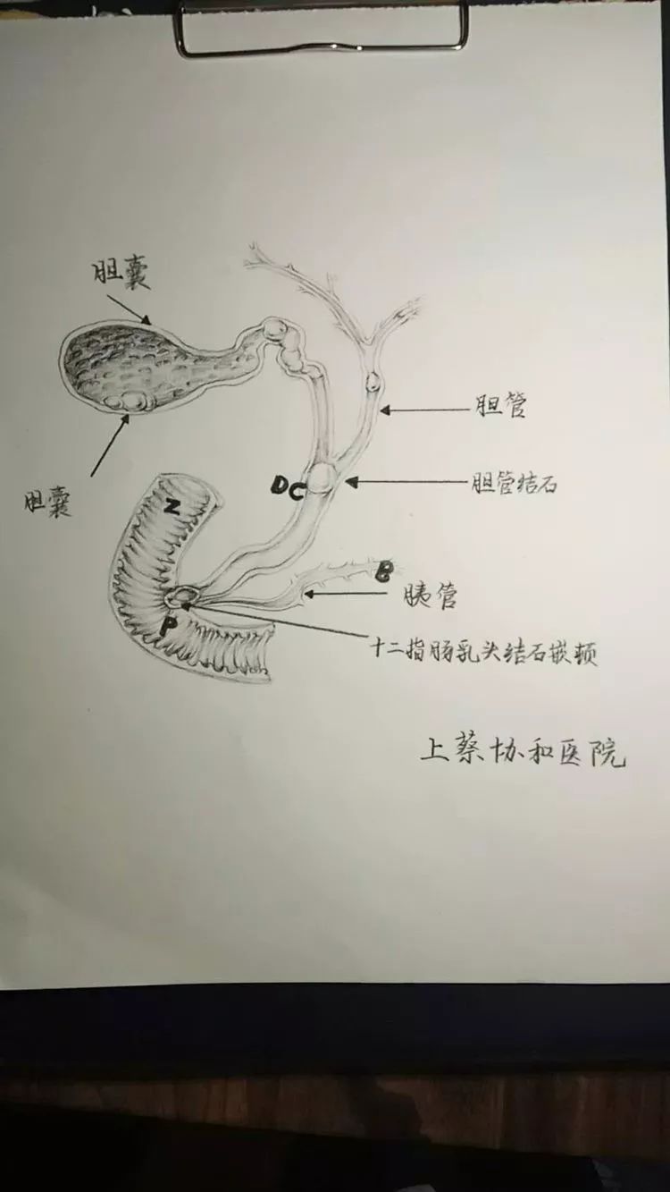 上蔡协和医院 | 外科为您唠一下"胆囊结石,胆管结石!