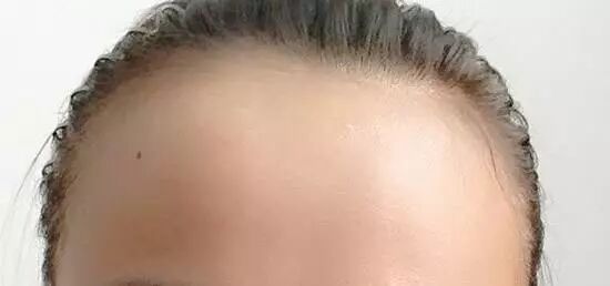 【植发课堂】发际线后移的原因是什么？