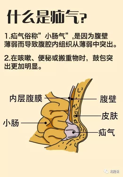 疝气的表现以及治疗方法——(上篇)[医学影像科普第62
