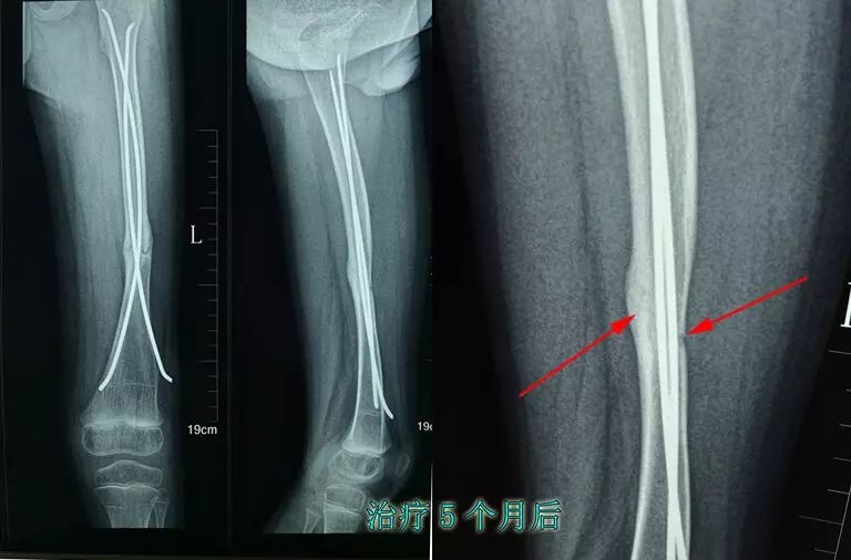 【病例】骨不连光靠内固定可不可以?