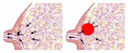 催乳秘密：哺乳期“堵奶了”大力揉，越揉越肿！