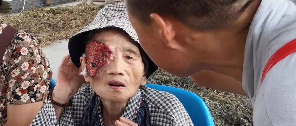 因果报应太可怕！一名80多岁的老太太脸上长严重的人面疮，太吓人！（有图有真相）
