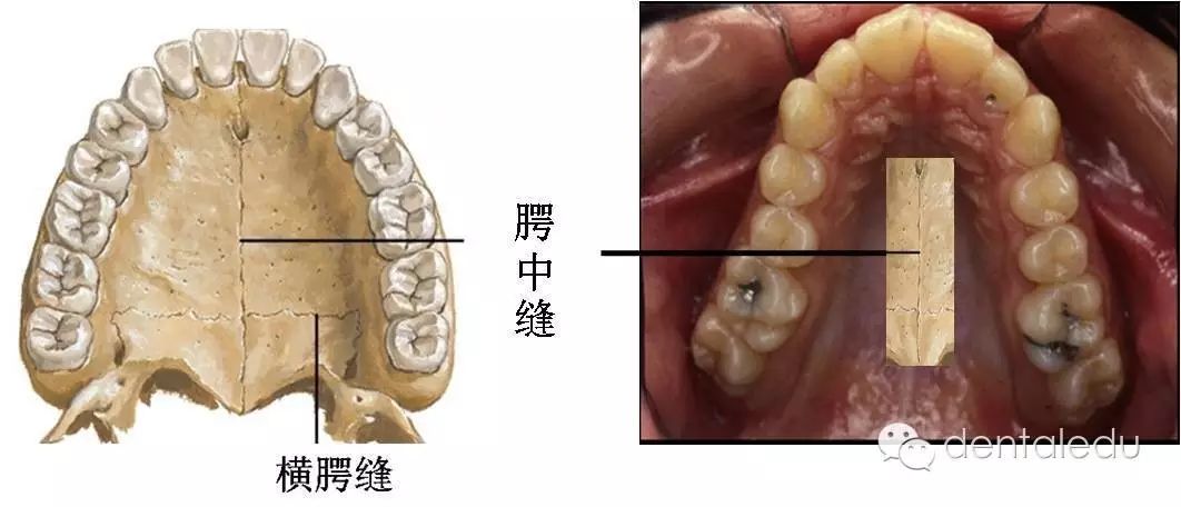 腭中缝如何判断其有无扩张潜力