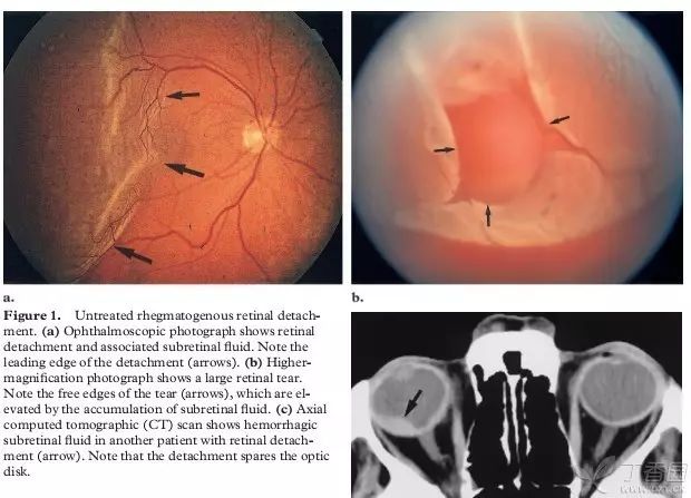 视网膜相关知识学习及病例图片分享