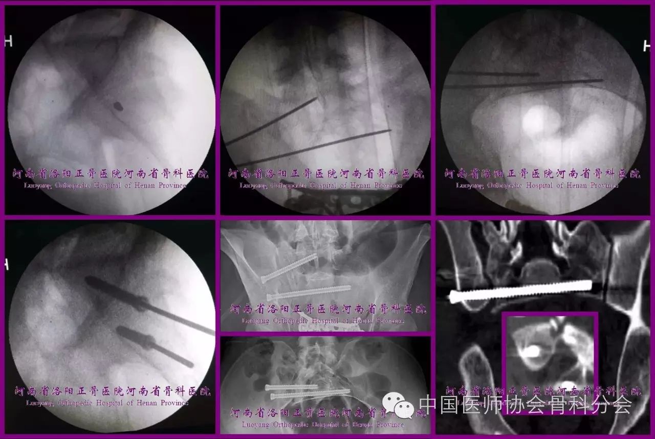 骨医小灶|分步详解骶髂螺钉的精准置钉技术