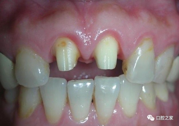 为什么医生镶一颗牙要磨两边的牙齿？