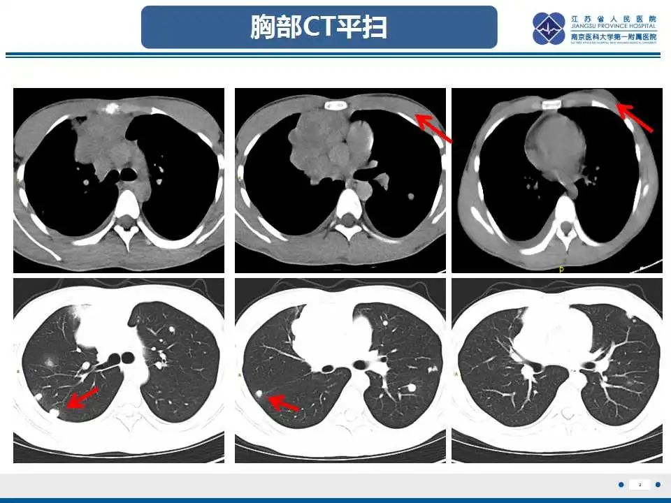 原发性纵隔绒毛膜癌影像表现67