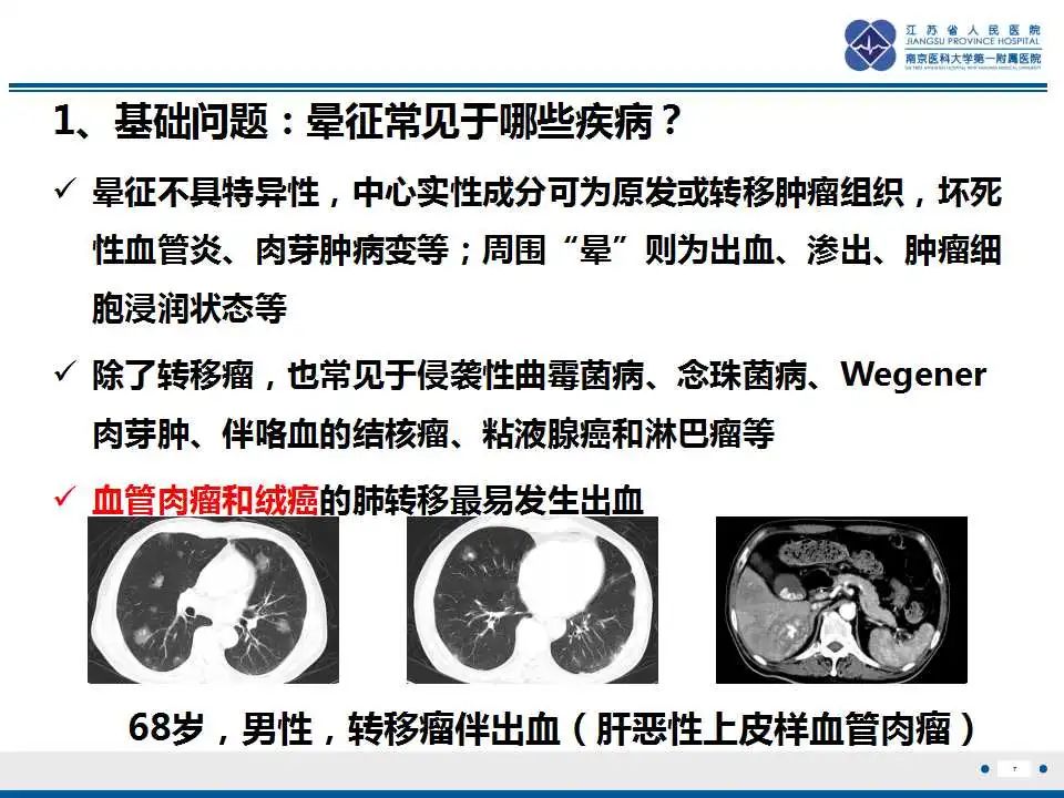 原发性纵隔绒毛膜癌影像表现67