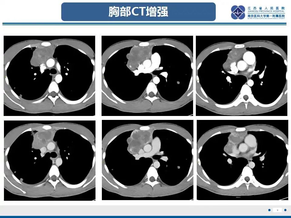 原发性纵隔绒毛膜癌影像表现67