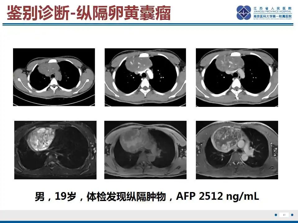 原发性纵隔绒毛膜癌影像表现67