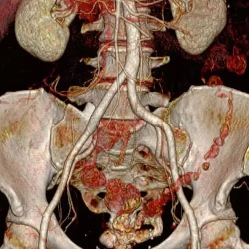 figure 2a左,右髂总动脉是由腹主动脉在l4椎体下缘水平发出的分支,沿