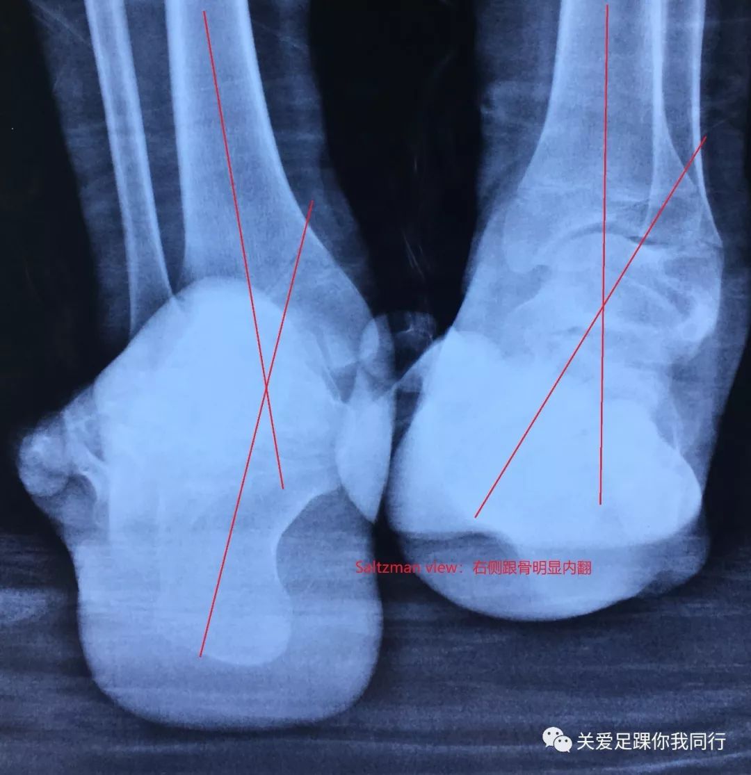 诊断: 1,高弓内翻畸形(右,神经