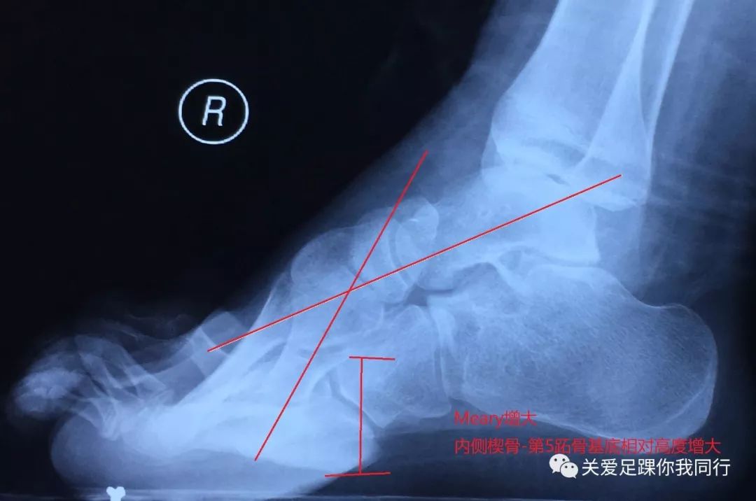 诊断: 1,高弓内翻畸形(右,神经