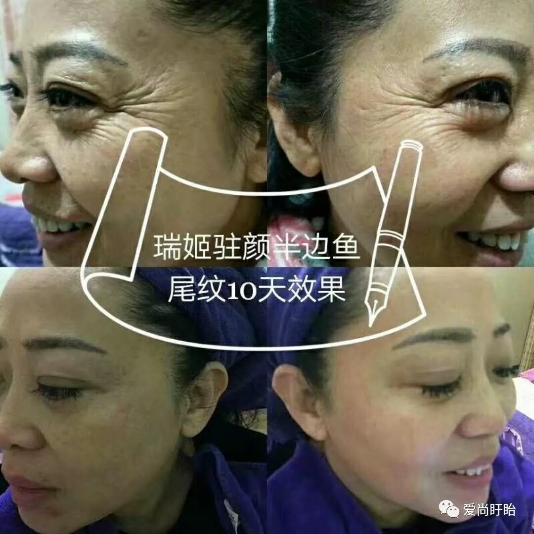 十大提升 八大皱纹:法令纹,口角纹,木偶纹纹,眼轮匝肌,鸡爪纹,川字