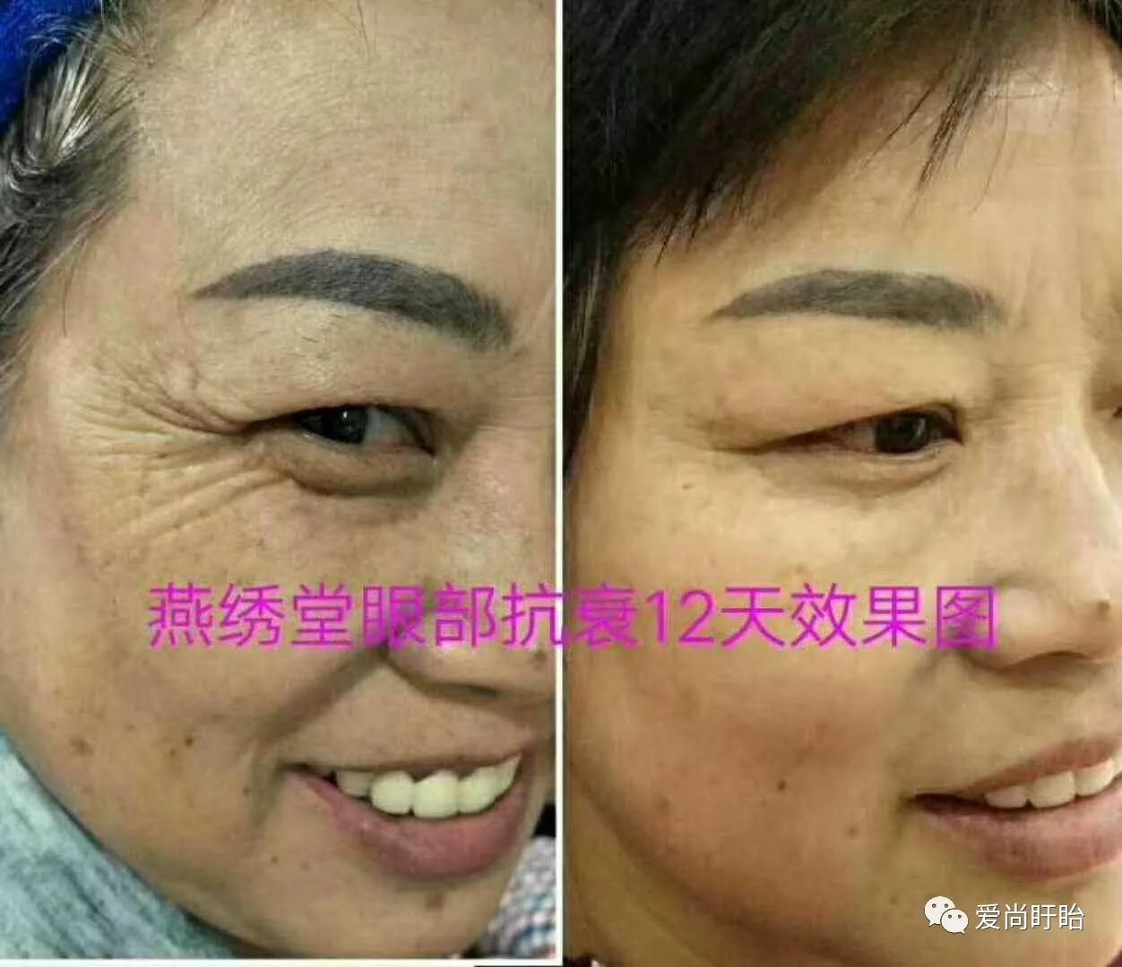 十大提升 八大皱纹:法令纹,口角纹,木偶纹纹,眼轮匝肌,鸡爪纹,川字
