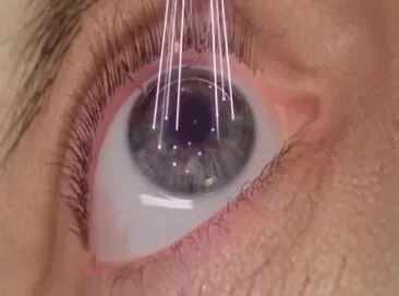全飞秒SMILE近视手术全攻略