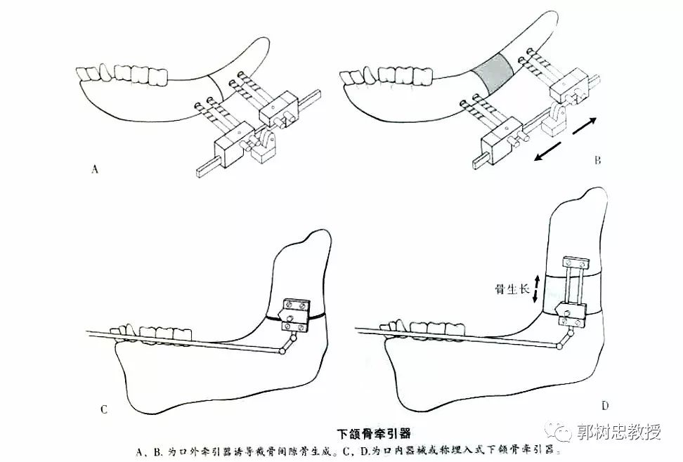 大小脸科普文章大小脸治疗方法四牵引成骨