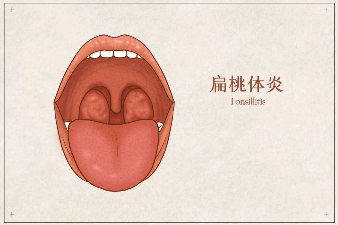 扁桃体老是发炎要不要割主要看这几种情况