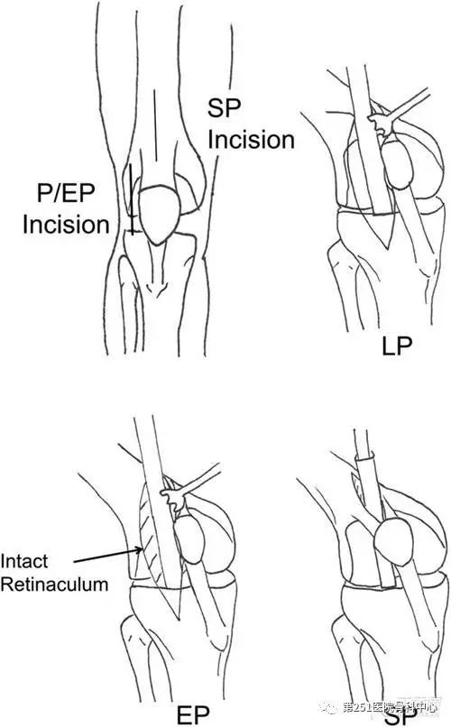 第三种手术入路,和第一种类似,切口可以在髌骨的内侧或外侧,唯一不同