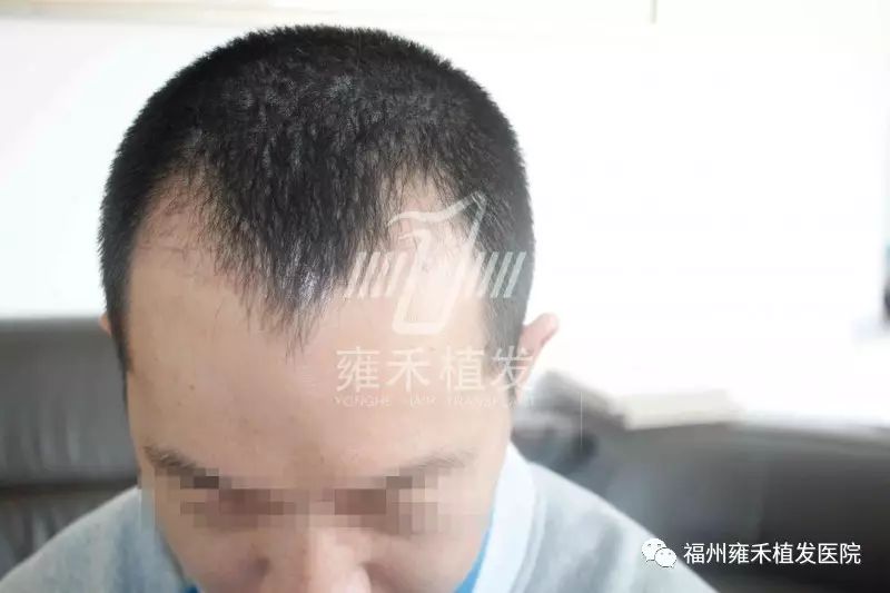 陈先生属于大m型脱发,主要是针对这两个额角进行植发