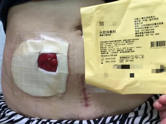 使用软凸面底盘,凸出造口,防止发生渗漏和造口回缩;7.