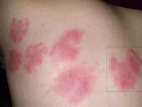 这里提醒各位家长:猩红热,麻疹和腮腺炎等也是门诊上儿童的常见病.