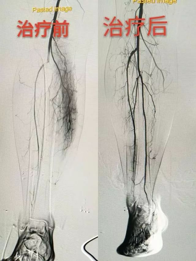 渭南市第二医院微创介入中心完成首例急性下肢动脉栓塞介入手术