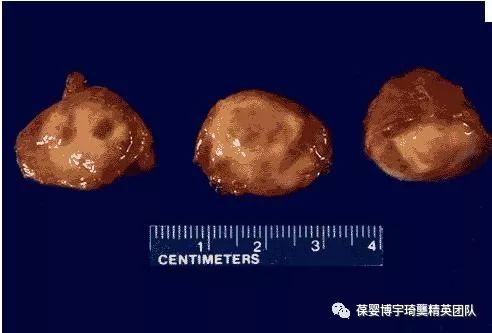 淋巴瘤究竟是什么样的病?