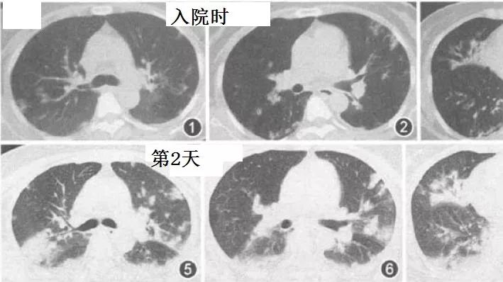 干货满满丨从国内首例H1N1,再谈流感合并肺炎的CT表现