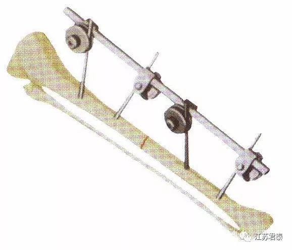 外固定支架1(骨科产品)简介